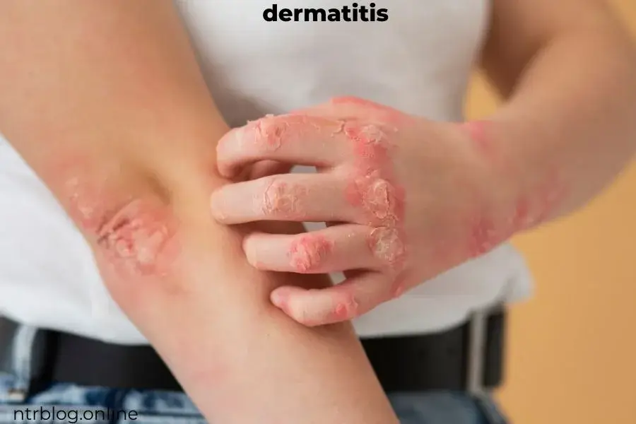 Eczema