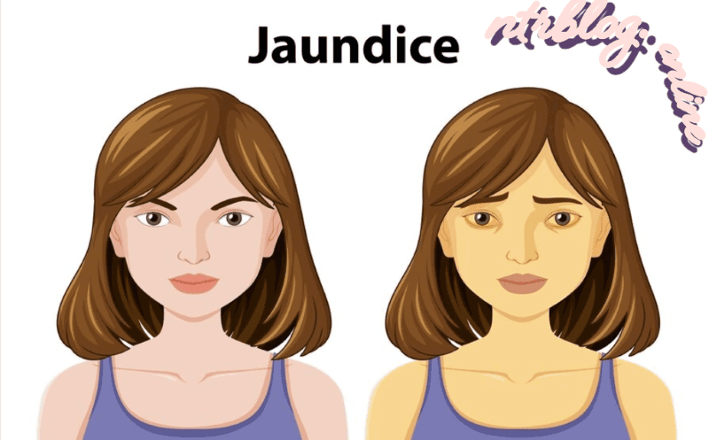 Jaundice